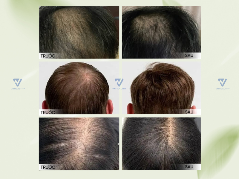Xịt dưỡng tóc Dr Hancy